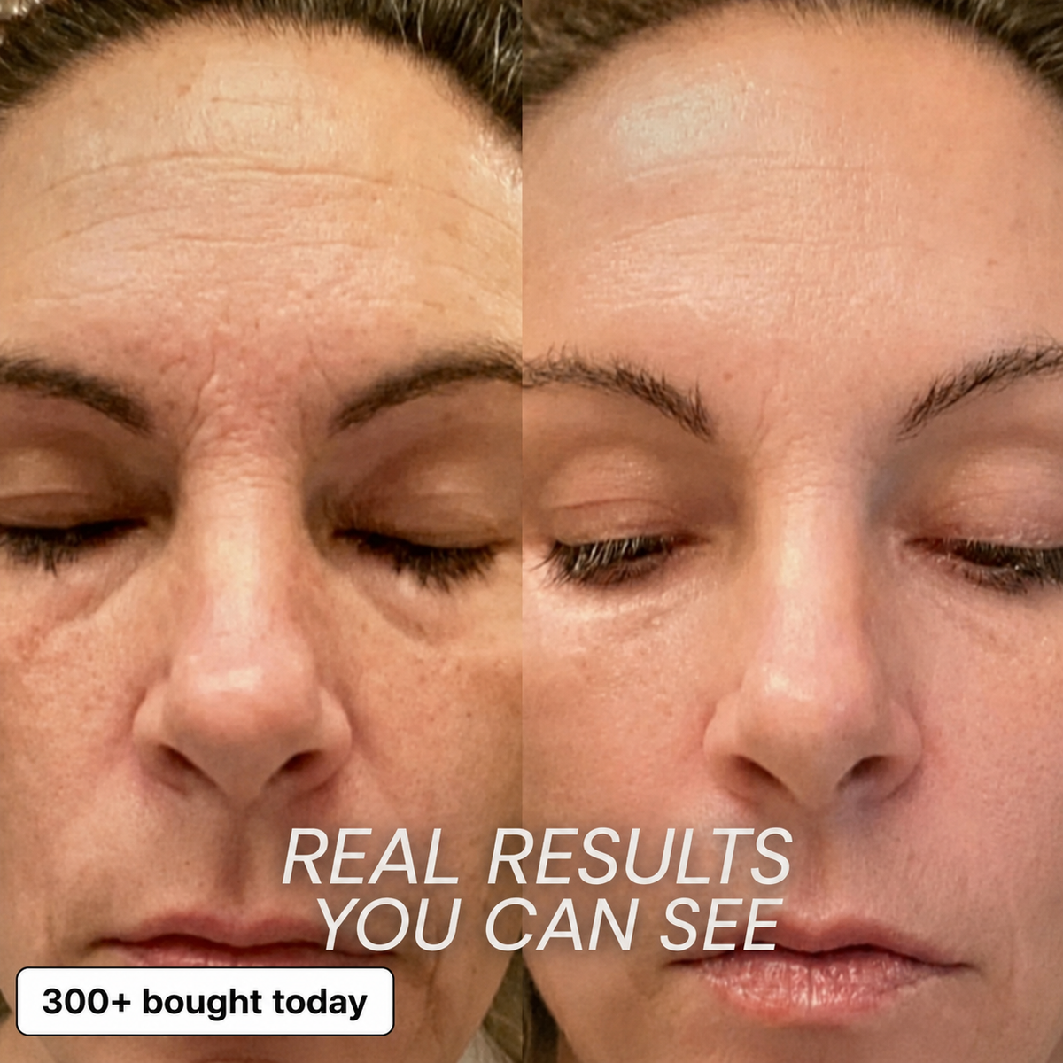Real forehead and face results